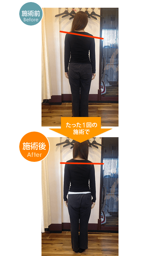 施術1回で肩のラインのズレが戻り、姿勢が改善されています。